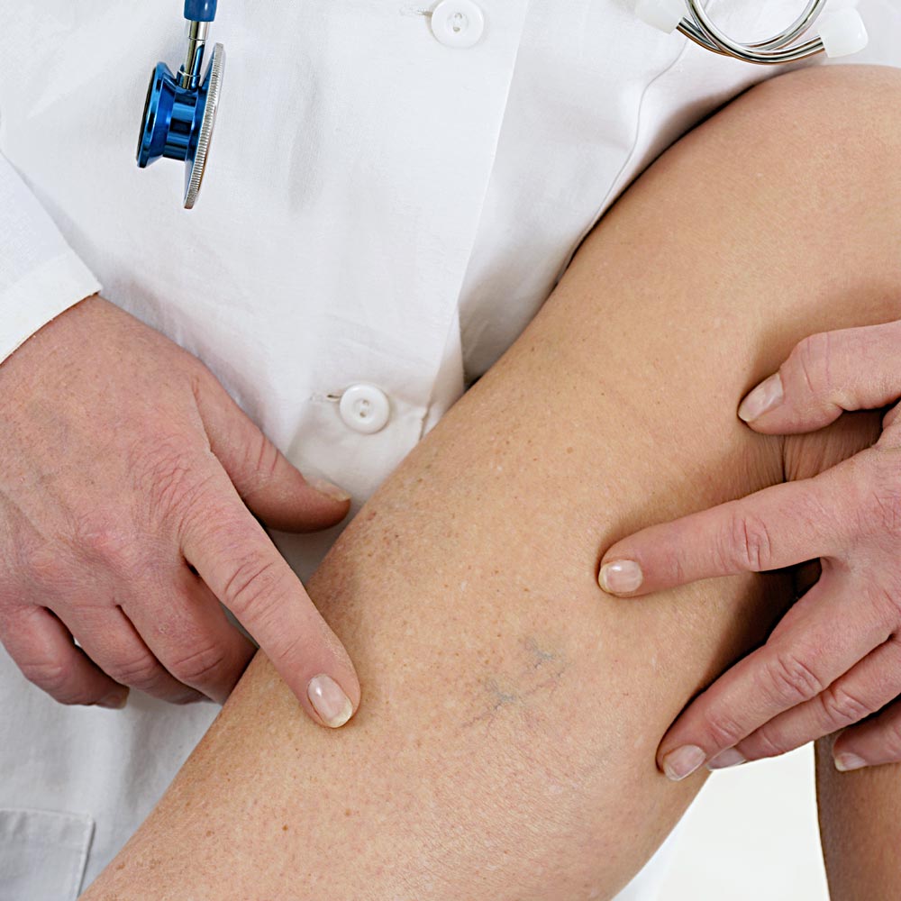 microsclerotherapy